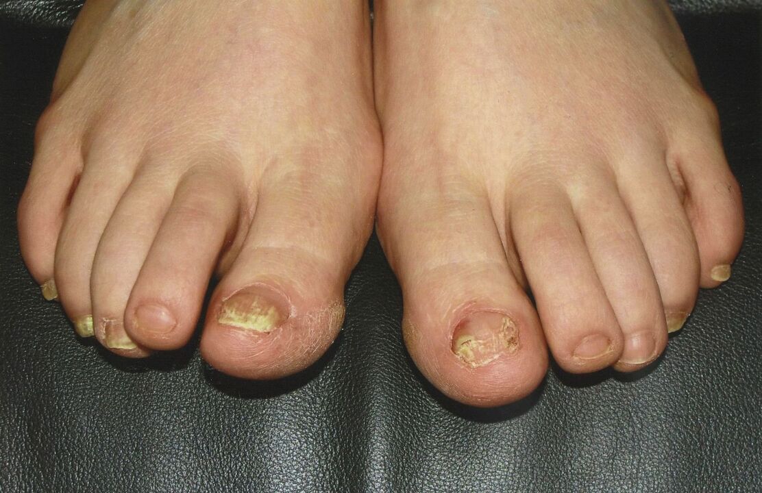 Wie man Zehennagelpilz mit Nagellack behandelt