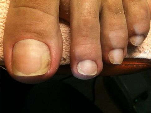 Pilzinfektion der Nagelplatte