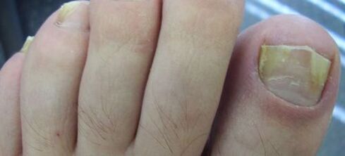 Symptome eines Nagelpilzes und dessen Behandlung mit Essig