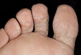 Die Haut der Füße mit einer Pilzinfektion