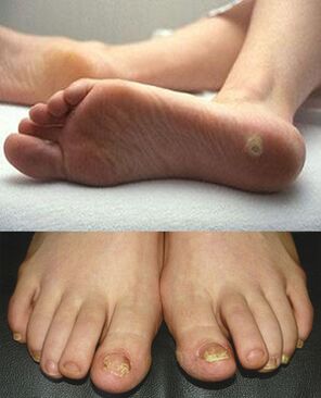 Manifestationen einer Mykose auf der Haut und den Nägeln der Füße