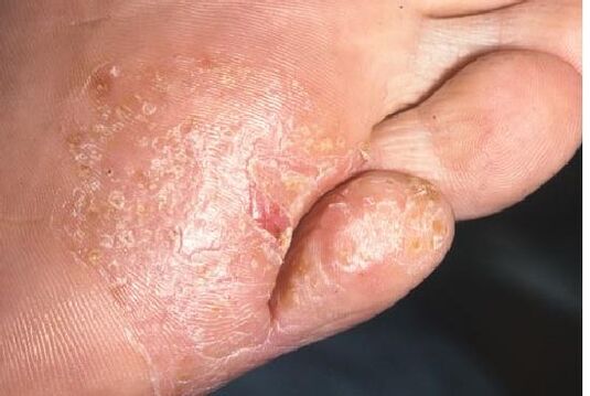 Manifestationen einer Pilzinfektion der Fußhaut