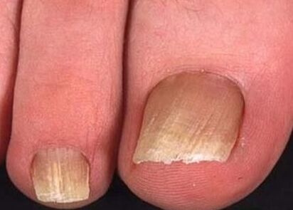 Nagelpilz an den Beinen der Anfangsstufe
