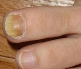 Symptome des Anfangsstadiums von Nagelpilz